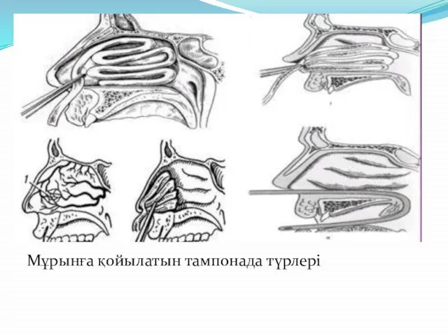 Мұрынға қойылатын тампонада түрлері