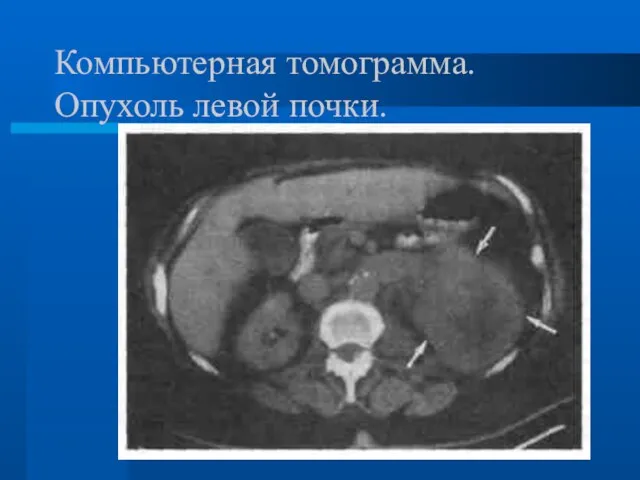 Компьютерная томограмма. Опухоль левой почки.