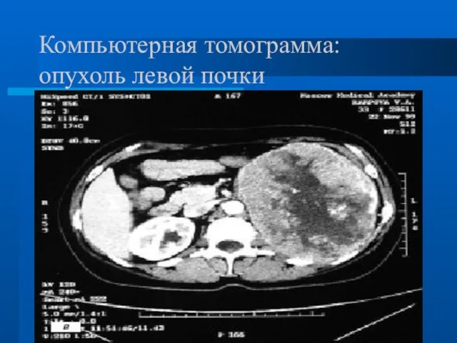 Компьютерная томограмма: опухоль левой почки