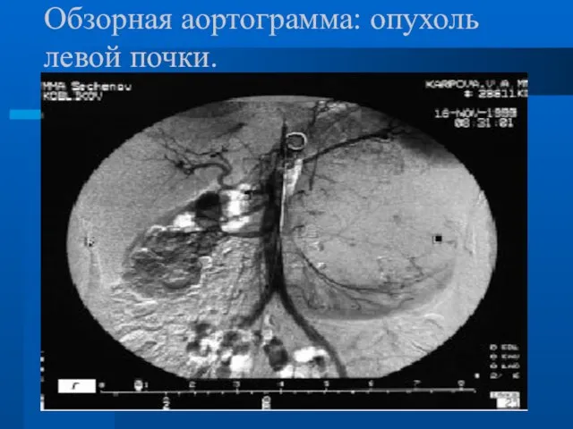 Обзорная аортограмма: опухоль левой почки.