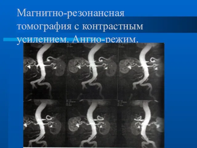 Магнитно-резонансная томография с контрастным усилением. Ангио-режим.