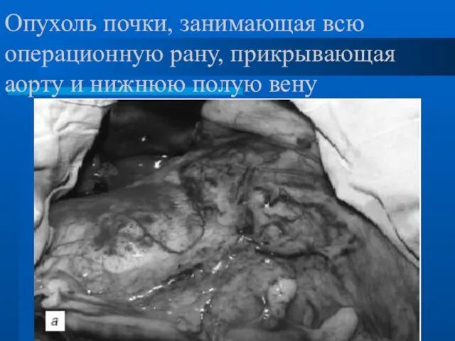Опухоль почки, занимающая всю операционную рану, прикрывающая аорту и нижнюю полую вену