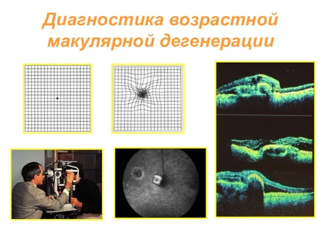 Диагностика возрастной макулярной дегенерации