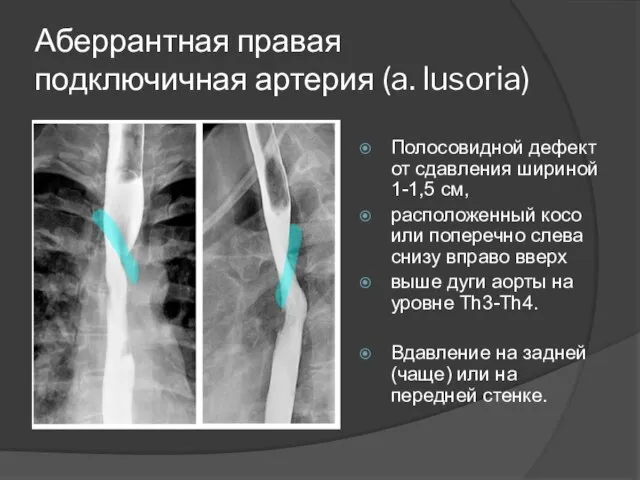 Аберрантная правая подключичная артерия (a. lusoria) Полосовидной дефект от сдавления шириной