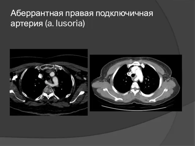 Аберрантная правая подключичная артерия (a. lusoria)