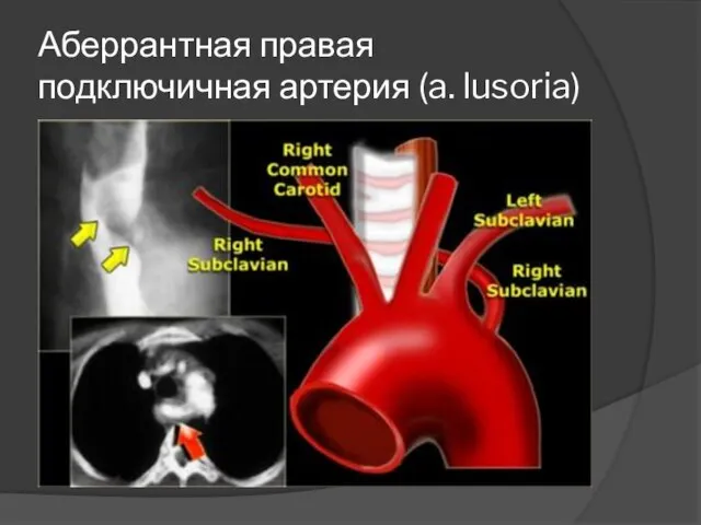 Аберрантная правая подключичная артерия (a. lusoria)