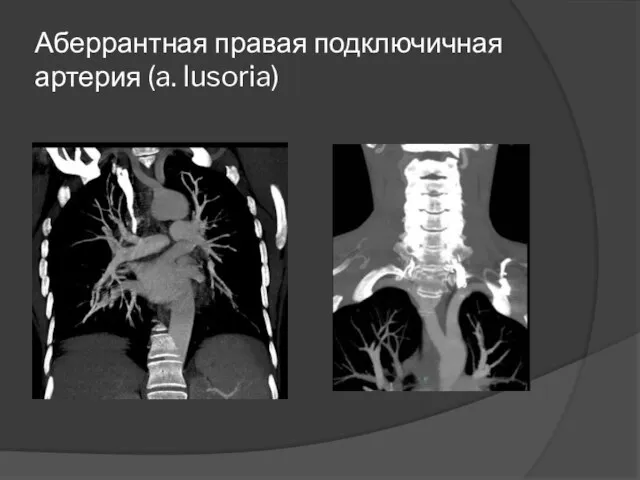 Аберрантная правая подключичная артерия (a. lusoria)