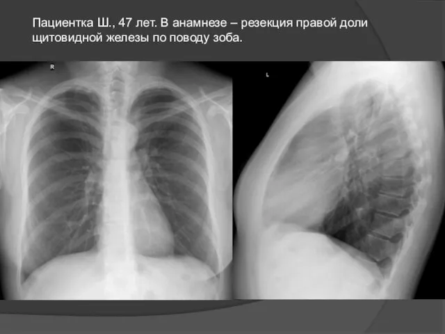 Пациентка Ш., 47 лет. В анамнезе – резекция правой доли щитовидной железы по поводу зоба.