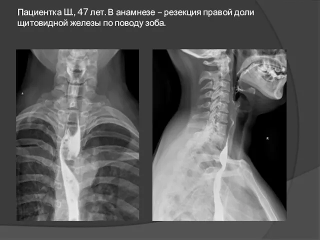 Пациентка Ш., 47 лет. В анамнезе – резекция правой доли щитовидной железы по поводу зоба.