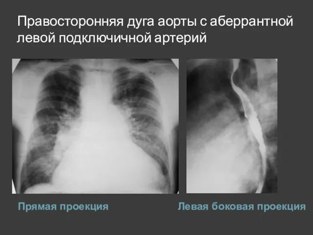 Правосторонняя дуга аорты с аберрантной левой подключичной артерий Прямая проекция Левая боковая проекция