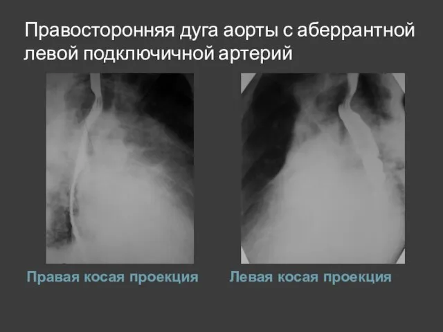 Правосторонняя дуга аорты с аберрантной левой подключичной артерий Правая косая проекция Левая косая проекция