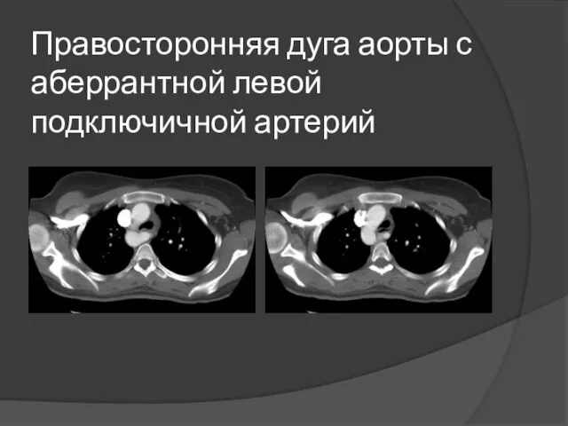 Правосторонняя дуга аорты с аберрантной левой подключичной артерий