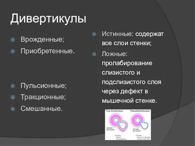 Дивертикулы Врожденные; Приобретенные. Пульсионные; Тракционные; Смешанные. Истинные: содержат все слои стенки;