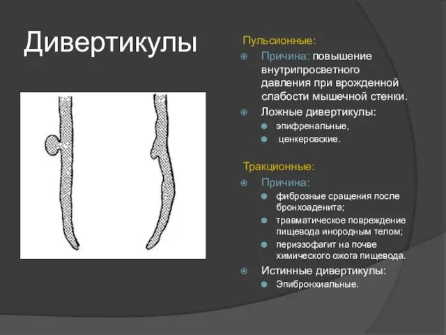 Дивертикулы Пульсионные: Причина: повышение внутрипросветного давления при врожденной слабости мышечной стенки.