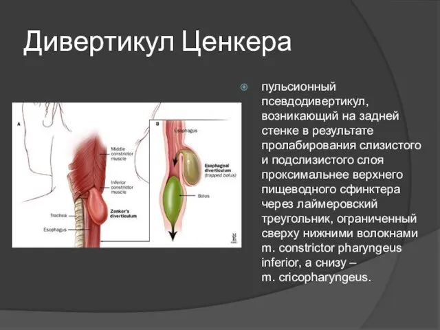 Дивертикул Ценкера пульсионный псевдодивертикул, возникающий на задней стенке в результате пролабирования