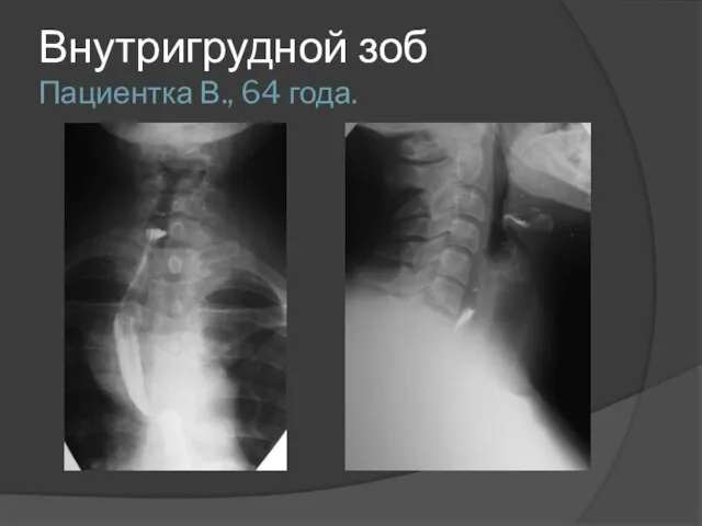 Внутригрудной зоб Пациентка В., 64 года.