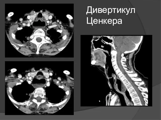 Дивертикул Ценкера