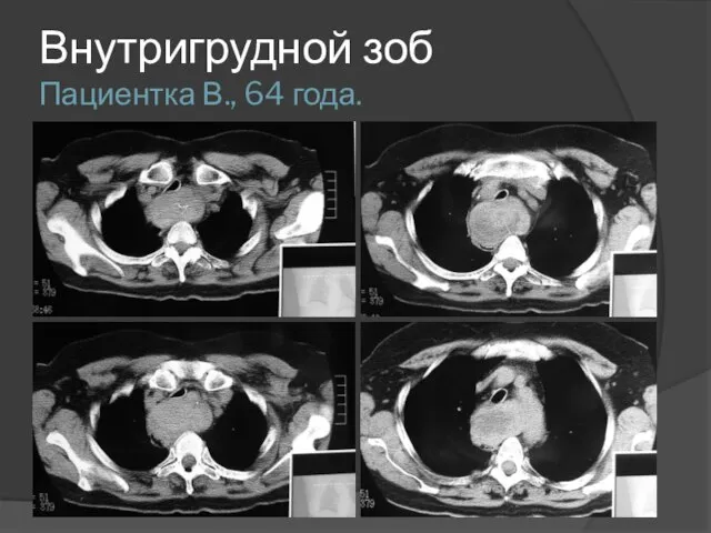 Внутригрудной зоб Пациентка В., 64 года.