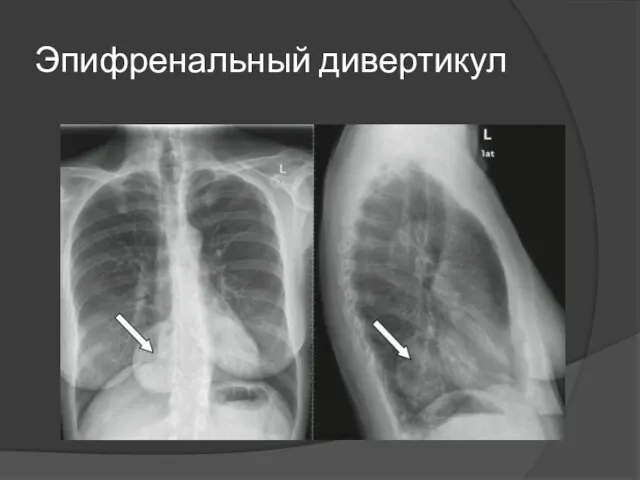 Эпифренальный дивертикул