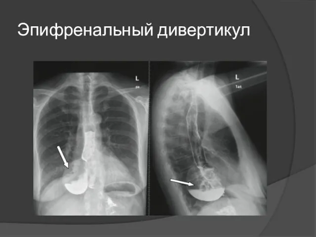 Эпифренальный дивертикул