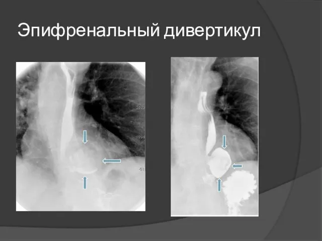 Эпифренальный дивертикул