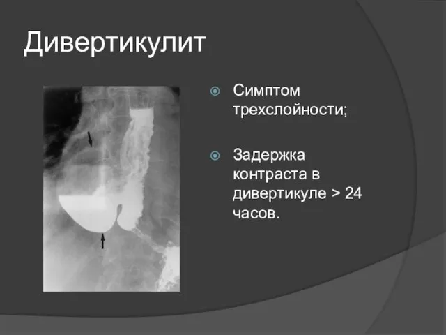 Дивертикулит Симптом трехслойности; Задержка контраста в дивертикуле > 24 часов.