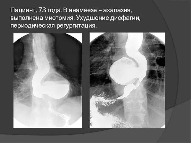 Пациент, 73 года. В анамнезе – ахалазия, выполнена миотомия. Ухудшение дисфагии, периодическая регургитация.