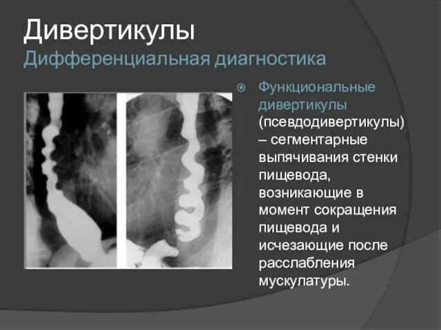 Дивертикулы Дифференциальная диагностика Функциональные дивертикулы (псевдодивертикулы) – сегментарные выпячивания стенки пищевода,