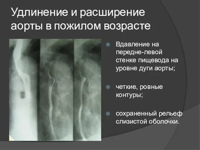 Удлинение и расширение аорты в пожилом возрасте Вдавление на передне-левой стенке