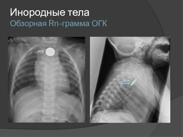 Инородные тела Обзорная Rn-грамма ОГК