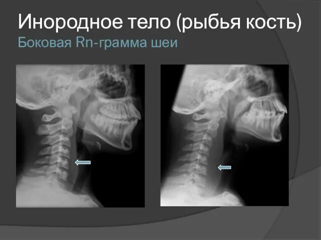 Инородное тело (рыбья кость) Боковая Rn-грамма шеи