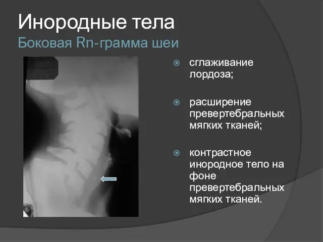 Инородные тела Боковая Rn-грамма шеи сглаживание лордоза; расширение превертебральных мягких тканей;