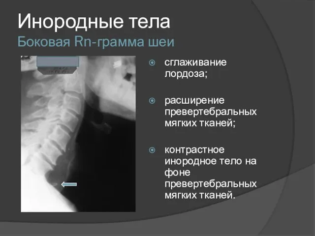 Инородные тела Боковая Rn-грамма шеи сглаживание лордоза; расширение превертебральных мягких тканей;