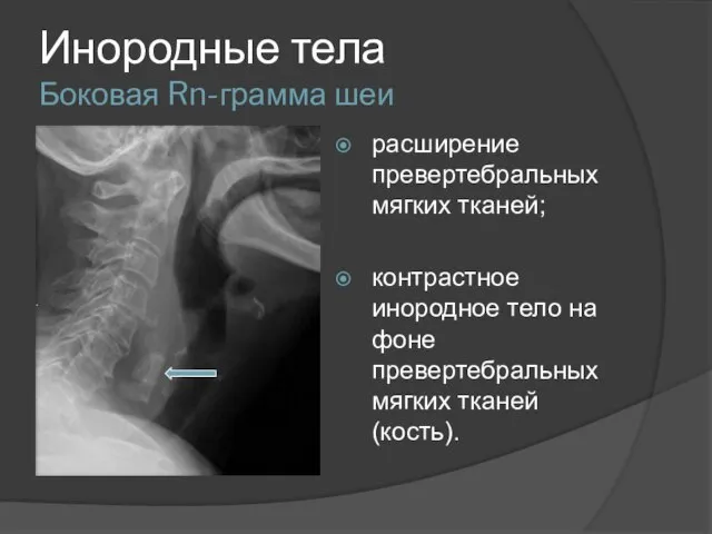 Инородные тела Боковая Rn-грамма шеи расширение превертебральных мягких тканей; контрастное инородное