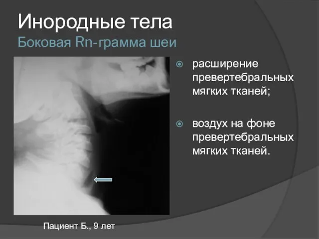 Инородные тела Боковая Rn-грамма шеи расширение превертебральных мягких тканей; воздух на