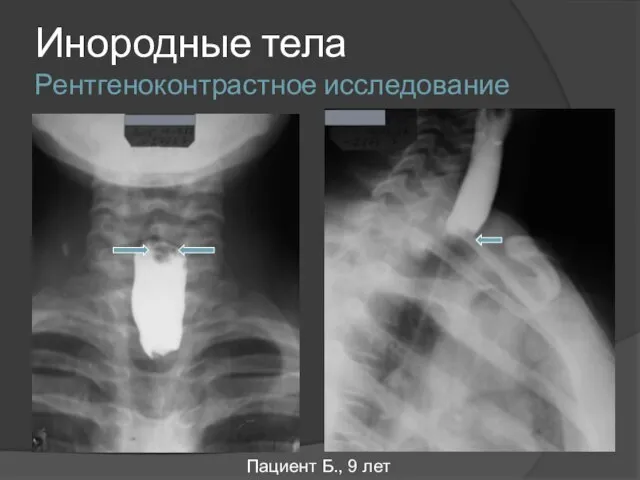 Инородные тела Рентгеноконтрастное исследование Пациент Б., 9 лет