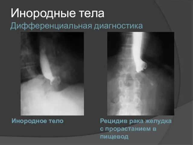 Инородные тела Дифференциальная диагностика Инородное тело Рецидив рака желудка с прорастанием в пищевод