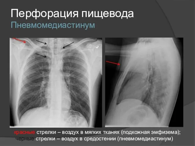 Перфорация пищевода Пневмомедиастинум красные стрелки – воздух в мягких тканях (подкожная