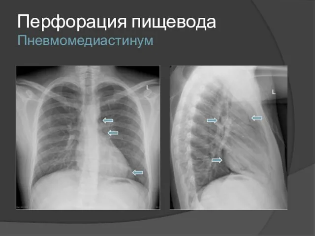 Перфорация пищевода Пневмомедиастинум