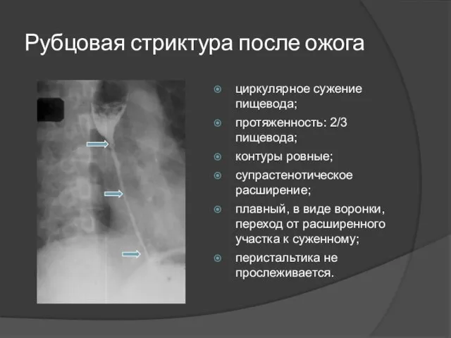 Рубцовая стриктура после ожога циркулярное сужение пищевода; протяженность: 2/3 пищевода; контуры