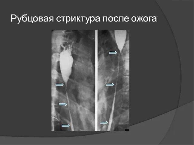 Рубцовая стриктура после ожога