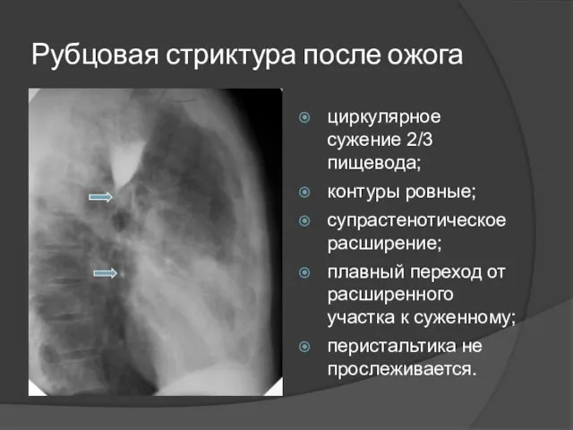 Рубцовая стриктура после ожога циркулярное сужение 2/3 пищевода; контуры ровные; супрастенотическое