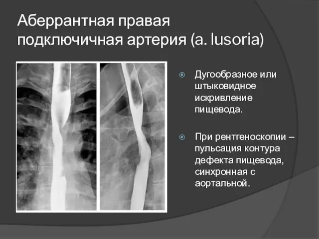 Аберрантная правая подключичная артерия (a. lusoria) Дугообразное или штыковидное искривление пищевода.