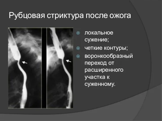 Рубцовая стриктура после ожога локальное сужение; четкие контуры; воронкообразный переход от расширенного участка к суженному.