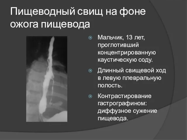 Пищеводный свищ на фоне ожога пищевода Мальчик, 13 лет, проглотивший концентрированную