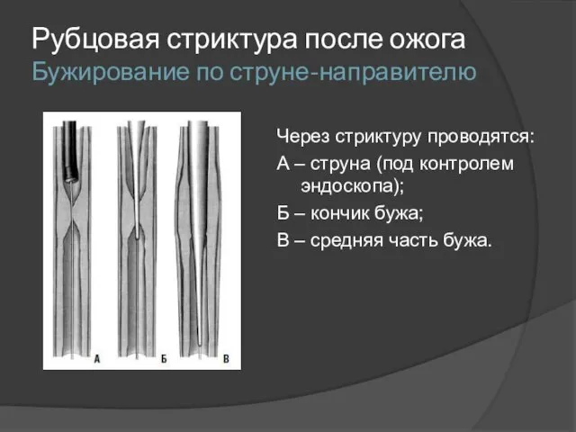 Рубцовая стриктура после ожога Бужирование по струне-направителю Через стриктуру проводятся: А