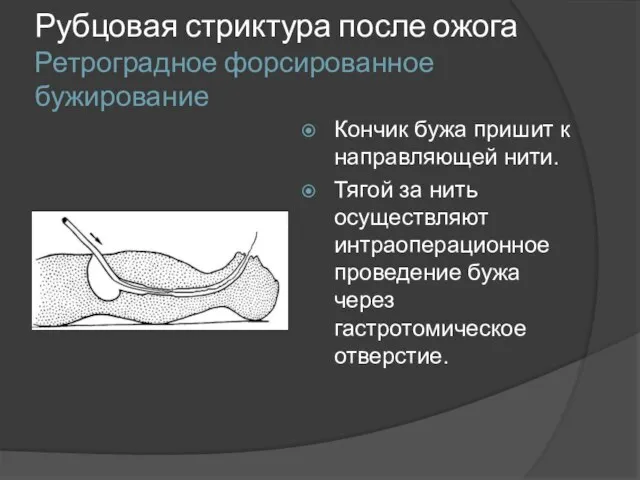 Рубцовая стриктура после ожога Ретроградное форсированное бужирование Кончик бужа пришит к