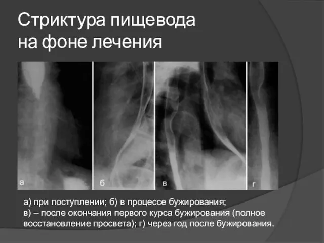 Стриктура пищевода на фоне лечения а) при поступлении; б) в процессе