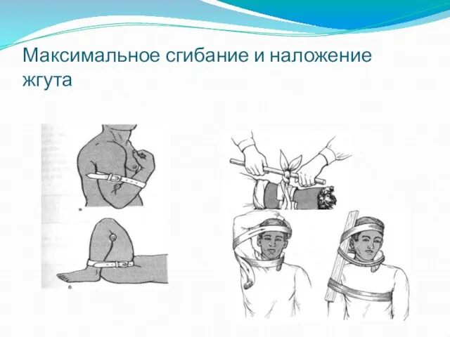 Максимальное сгибание и наложение жгута