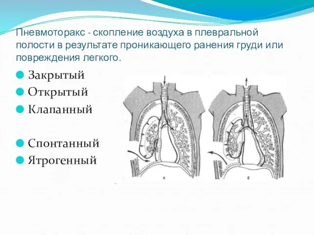 Пневмоторакс - скопление воздуха в плевральной полости в результате проникающего ранения